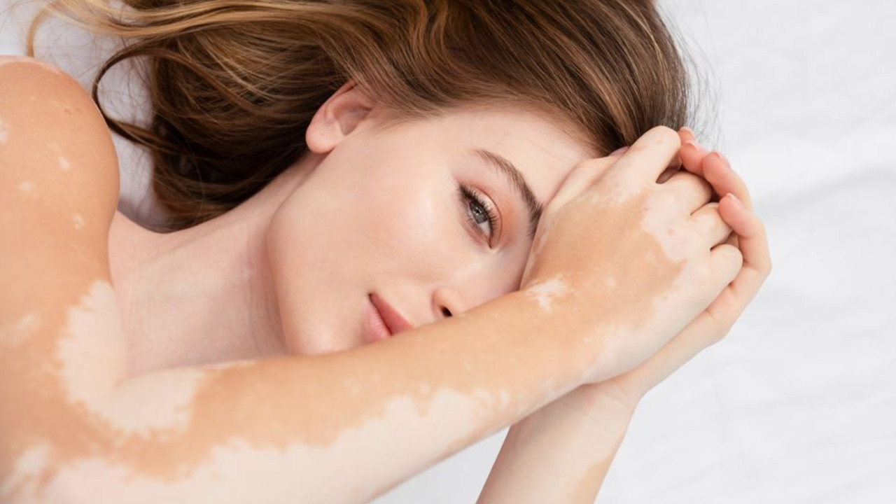 Ayurvedic Treatment for Vitiligo: Restoring Skin Health