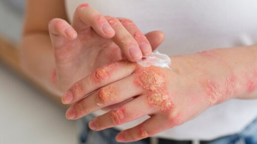 Permanent Cure for Eczema in Ayurveda: Revitalizing Skin Health